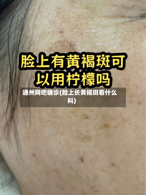 通州网吧确诊(脸上长黄褐斑看什么科)